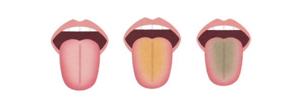 舌苔の違いを説明するイラスト